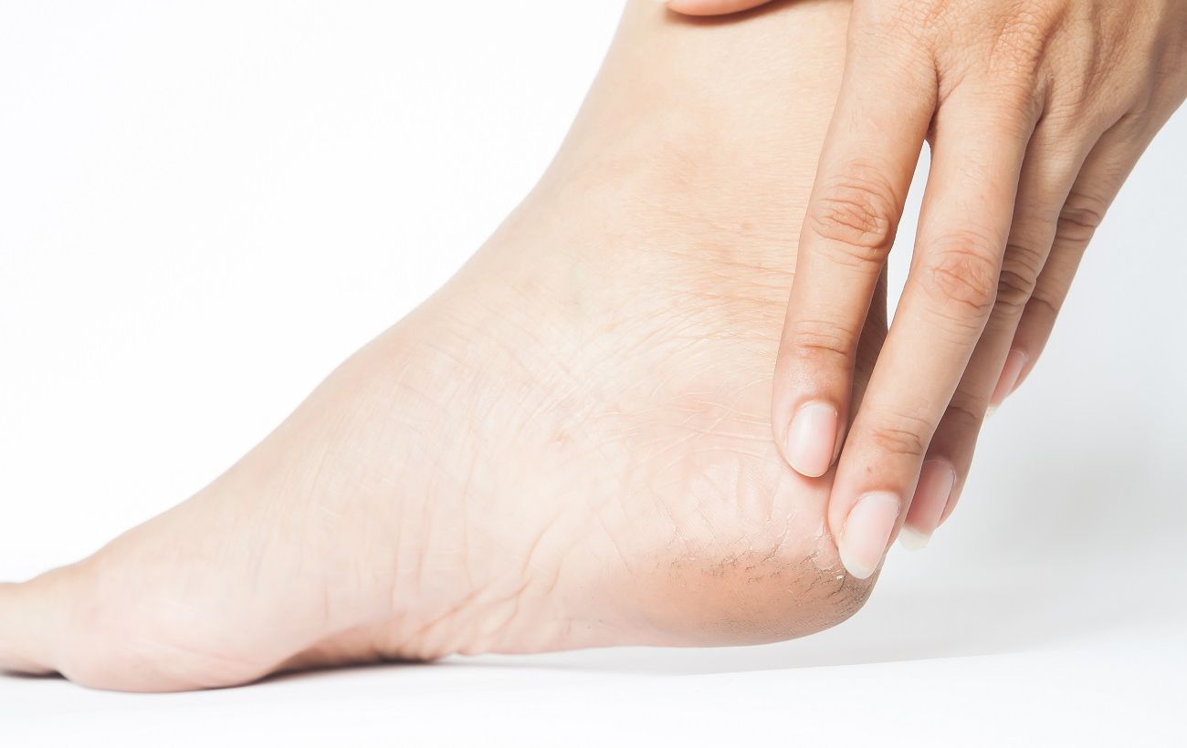 Зображення новини: Більше ніяких тріщин: як вилікувати п’яти вдома та не проґавити небезпечний симптом