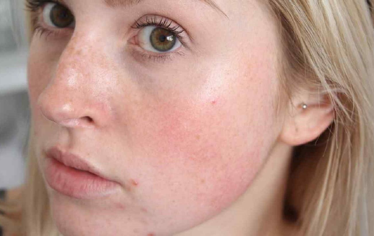 Зображення новини: Обличчя раптово червоніє? На це є 6 причин - і це не завжди алергія