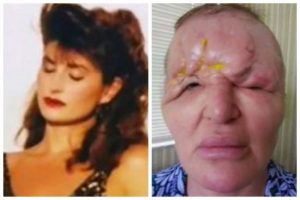 Модель стала схожою на “монстра” та заклеювала очі скотчем після невдалої процедури: фото до і після